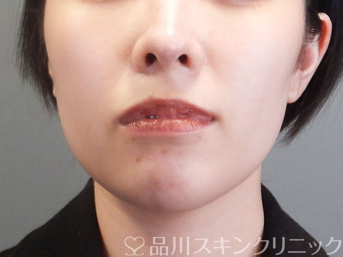 症例NO.72980のBEFORE写真