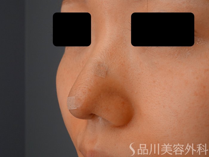 症例NO.62095のAFTER写真
