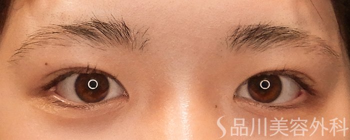 症例NO.69928のAFTER写真