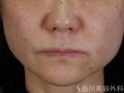 症例NO.72353のAFTER写真