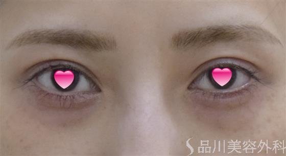 症例NO.54911のBEFORE写真