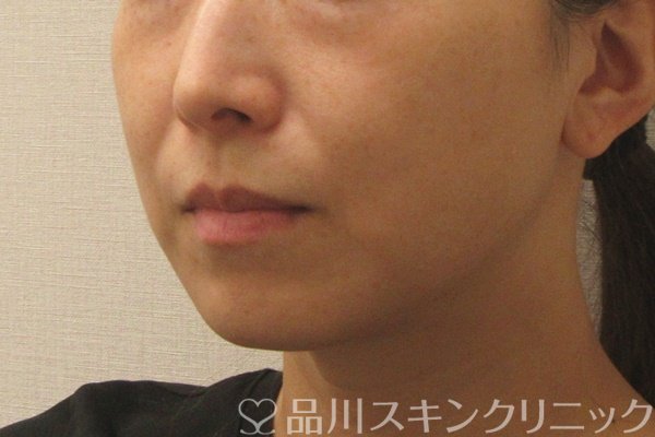 症例NO.73965のBEFORE写真
