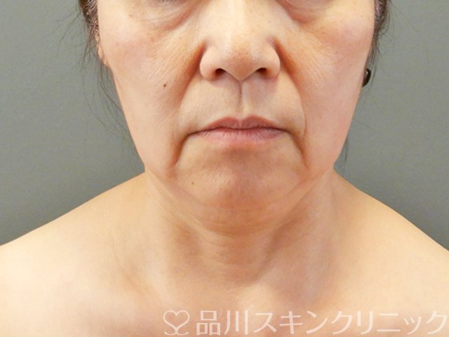 症例NO.67753のBEFORE写真