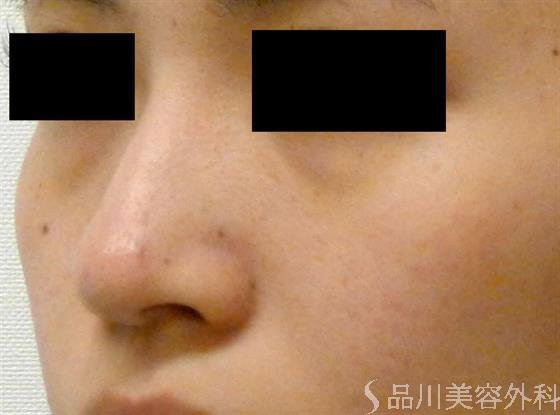 症例NO.39511のAFTER写真