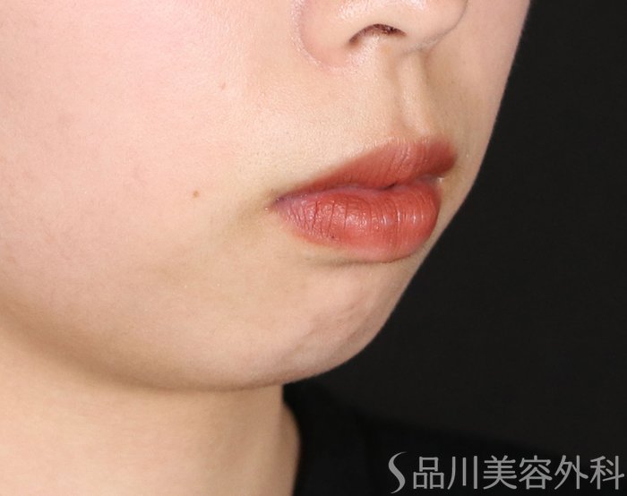 症例NO.73892のBEFORE写真