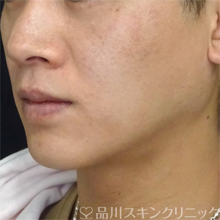 症例NO.69605のBEFORE写真