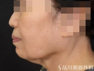 症例NO.71030のBEFORE写真