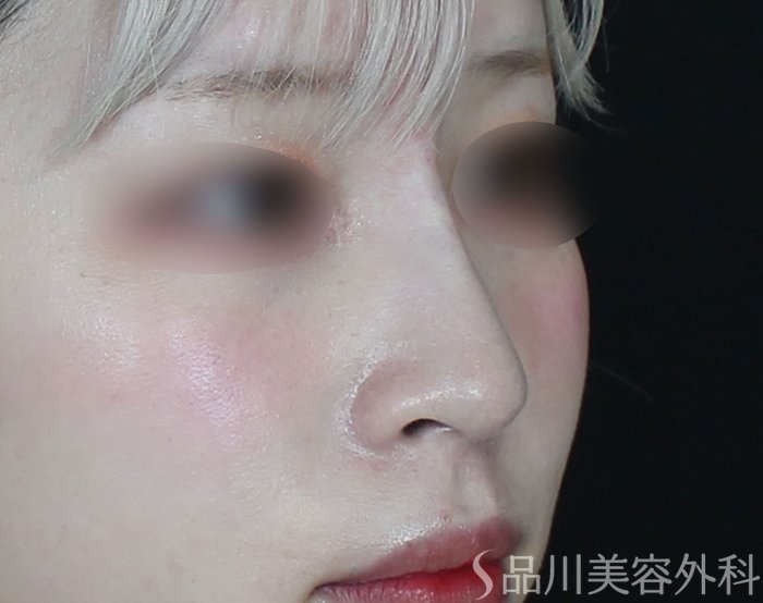 症例NO.69657のAFTER写真
