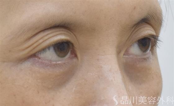 症例NO.52197のBEFORE写真