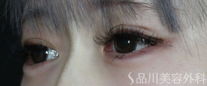 症例NO.73391のAFTER写真