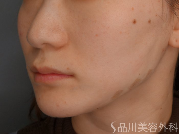 症例NO.73627のAFTER写真