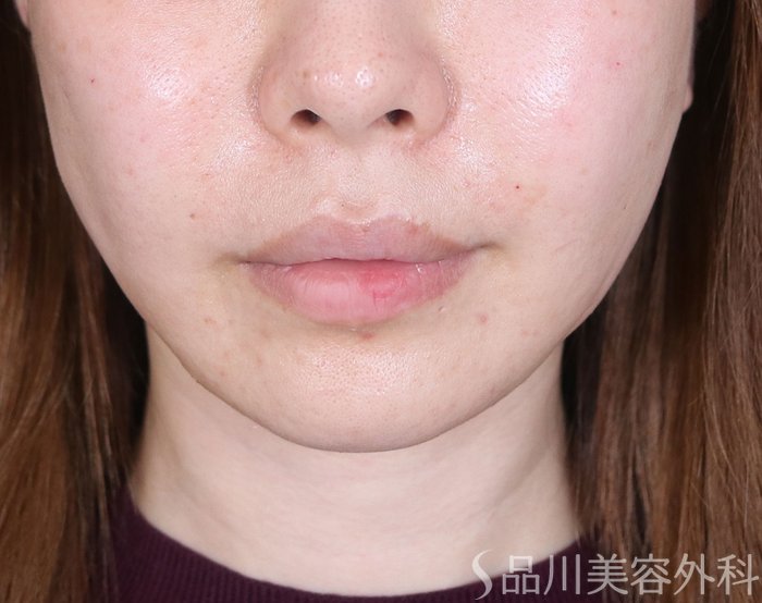 症例NO.73261のAFTER写真