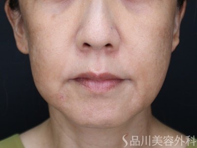 症例NO.71497のBEFORE写真