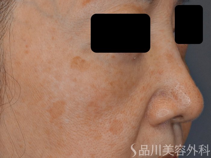 症例NO.73964のBEFORE写真