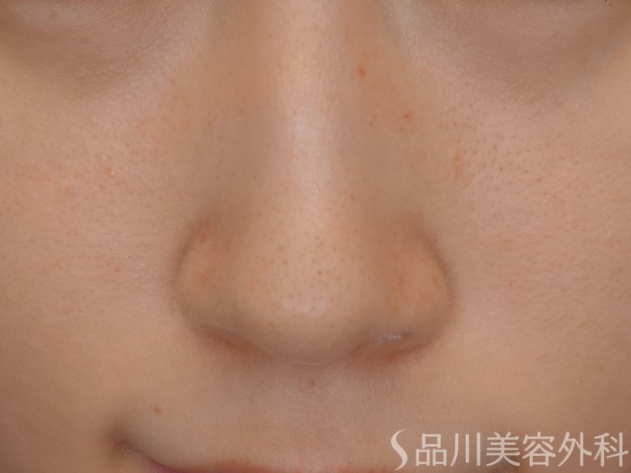 症例NO.67090のBEFORE写真