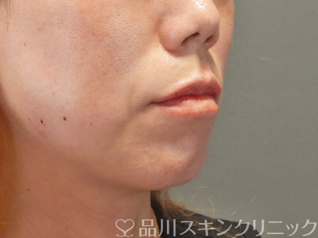 症例NO.75039のAFTER写真