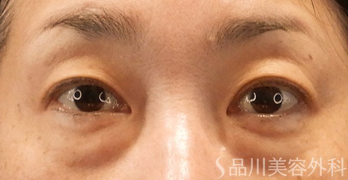 症例NO.70565のBEFORE写真