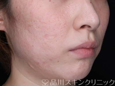 症例NO.74863のAFTER写真