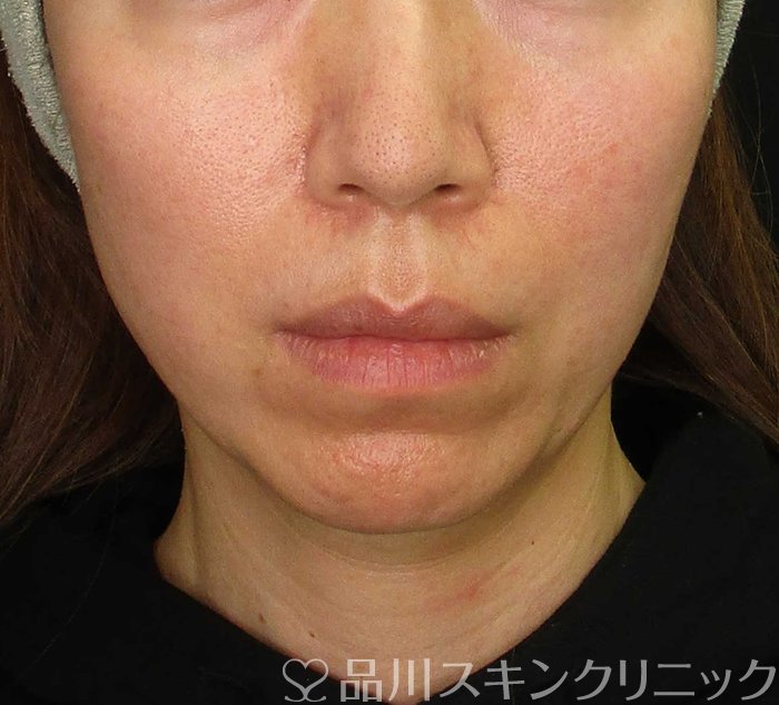 症例NO.68379のBEFORE写真