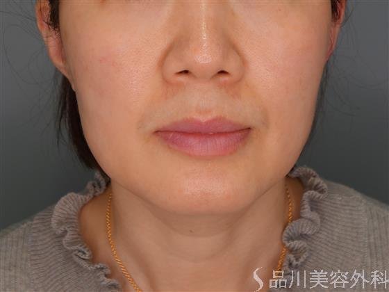 症例NO.53594のBEFORE写真