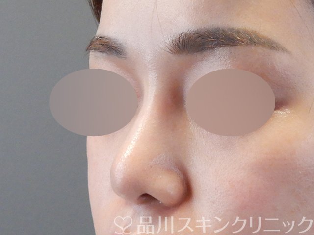症例NO.67385のAFTER写真