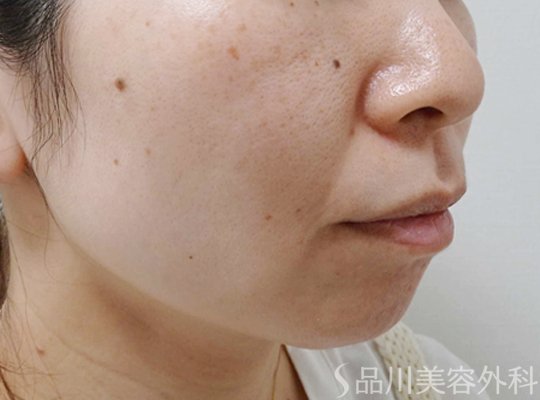 症例NO.74061のBEFORE写真