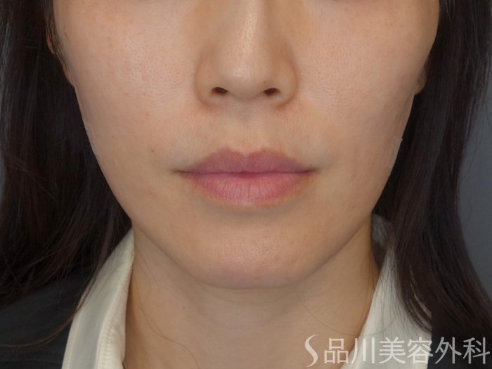 症例NO.71916のAFTER写真