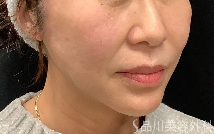 症例NO.67964のAFTER写真