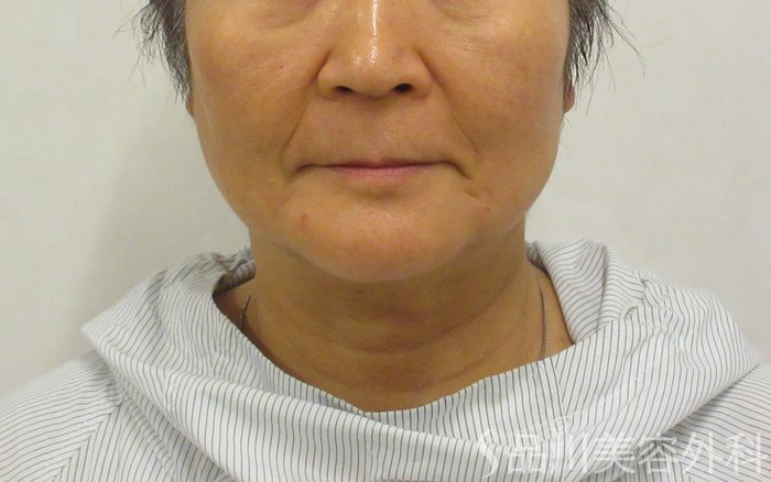 症例NO.72563のBEFORE写真