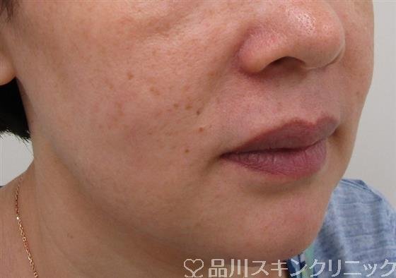 症例NO.37445のBEFORE写真