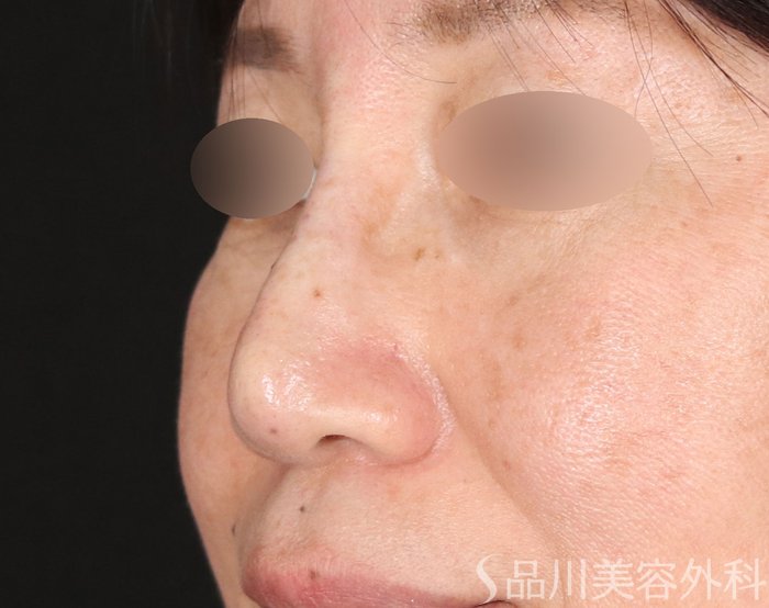 症例NO.72261のBEFORE写真