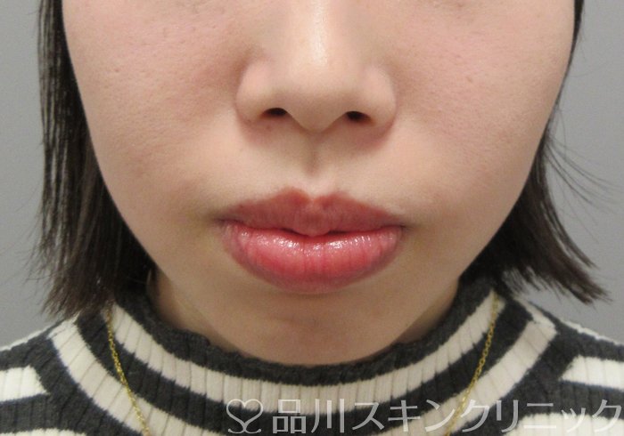 症例NO.69808のBEFORE写真