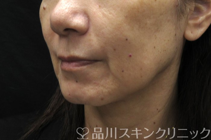 症例NO.74763のBEFORE写真