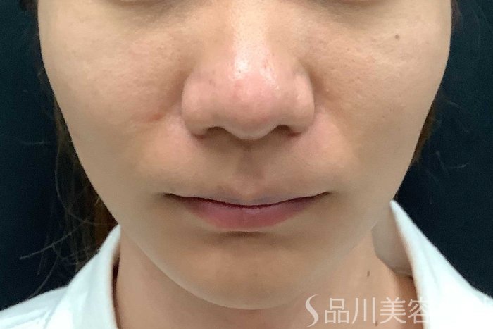 症例NO.63006のBEFORE写真