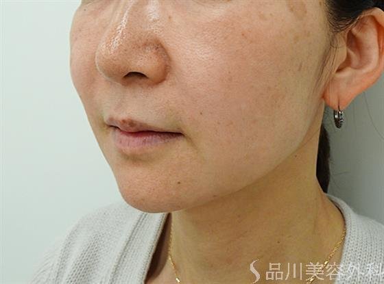 症例NO.44611のAFTER写真