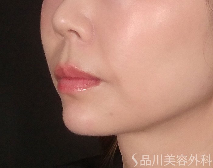 症例NO.70458のAFTER写真