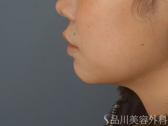 症例NO.72470のBEFORE写真