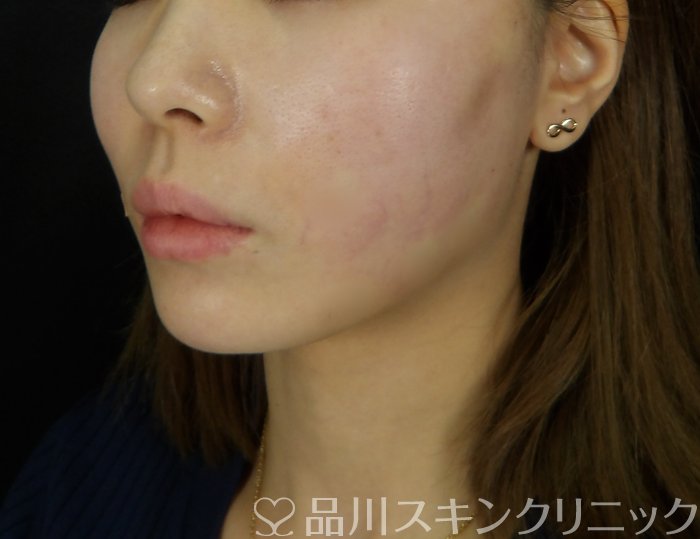 症例NO.72637のAFTER写真