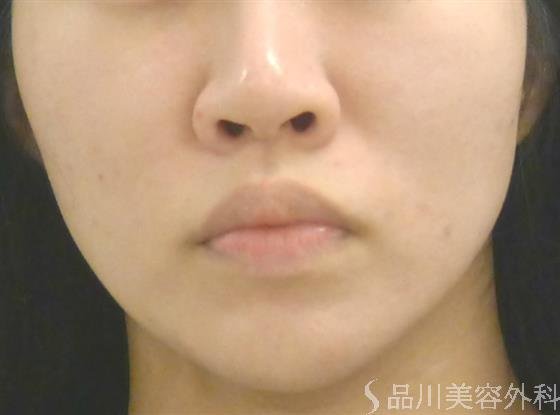 症例NO.40697のBEFORE写真