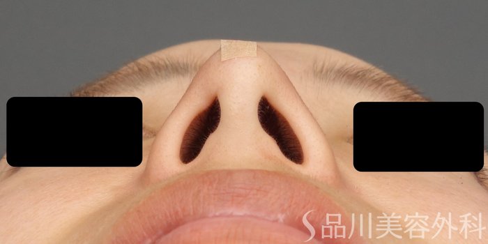 症例NO.64968のAFTER写真