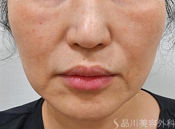 症例NO.61834のBEFORE写真