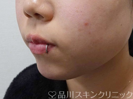 症例NO.64622のAFTER写真