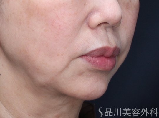 症例NO.72376のBEFORE写真