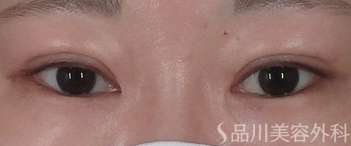 症例NO.69201のAFTER写真