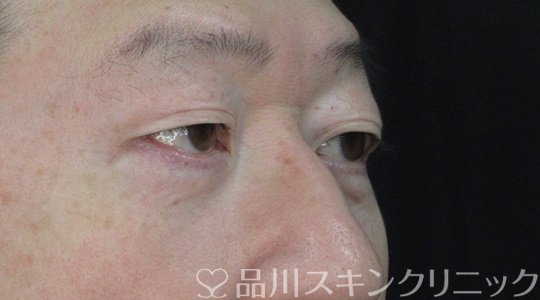 症例NO.72096のAFTER写真