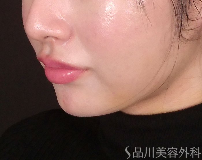 症例NO.69590のAFTER写真