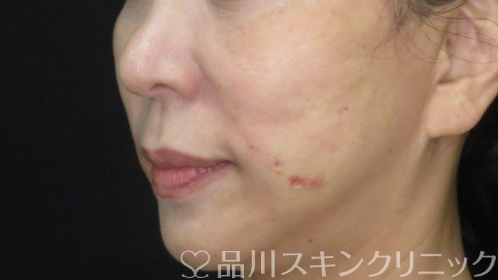 症例NO.72064のAFTER写真