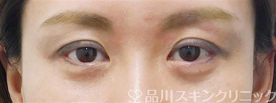 症例NO.51280のAFTER写真