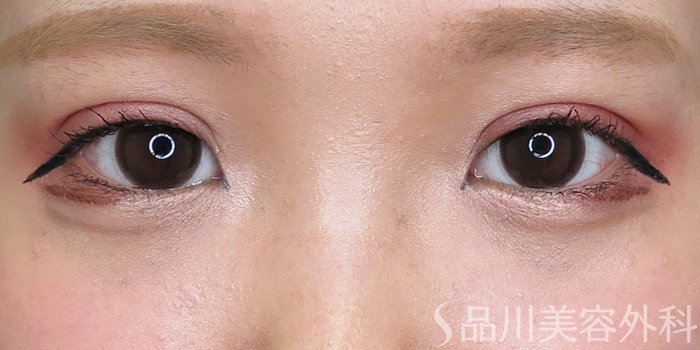 症例NO.71398のAFTER写真
