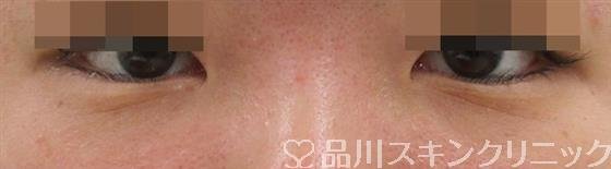 症例NO.41089のBEFORE写真